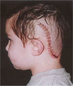 Matthew Post-op with suture line